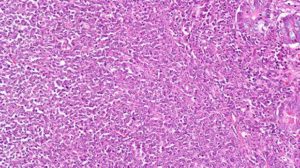 Diffuse large B cell lymphoma cells