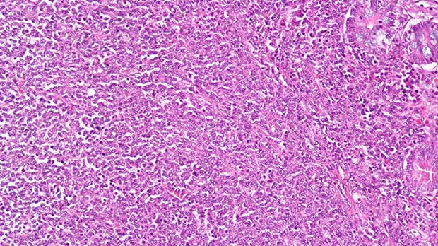 Diffuse large B cell lymphoma cells