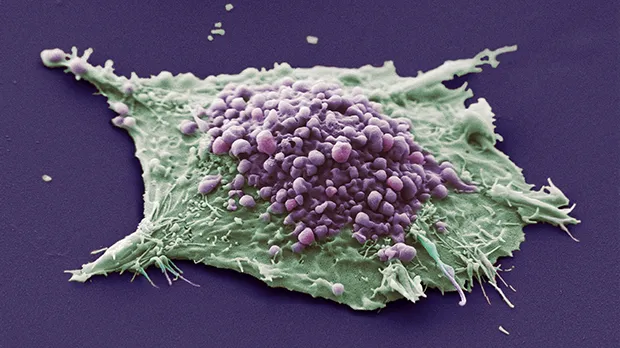 Lung cancer cell under a microscope