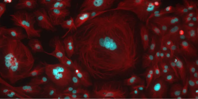 Ovarian cancer cells visualised using immunofluorescence markers