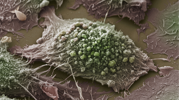 A microscope image of a lung cancer cell