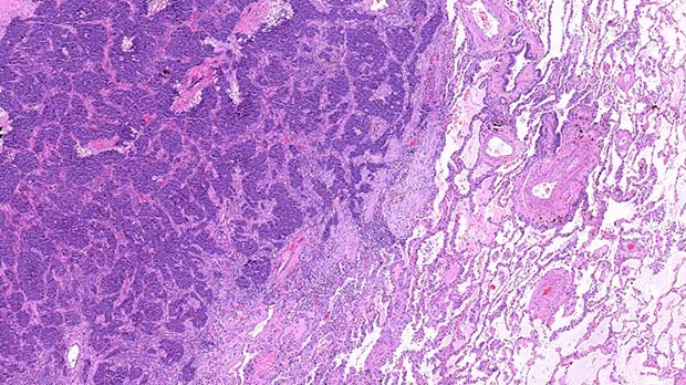 An area of lung tissue showing lung cancer to the left.