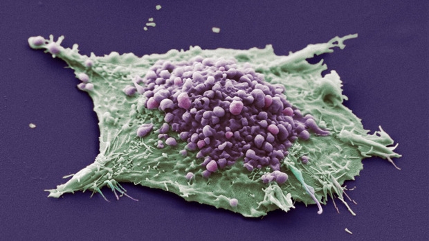 Lung cancer cell