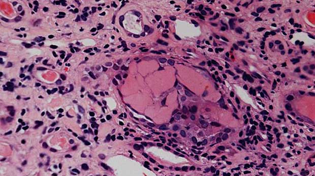 Histopathology of myeloma