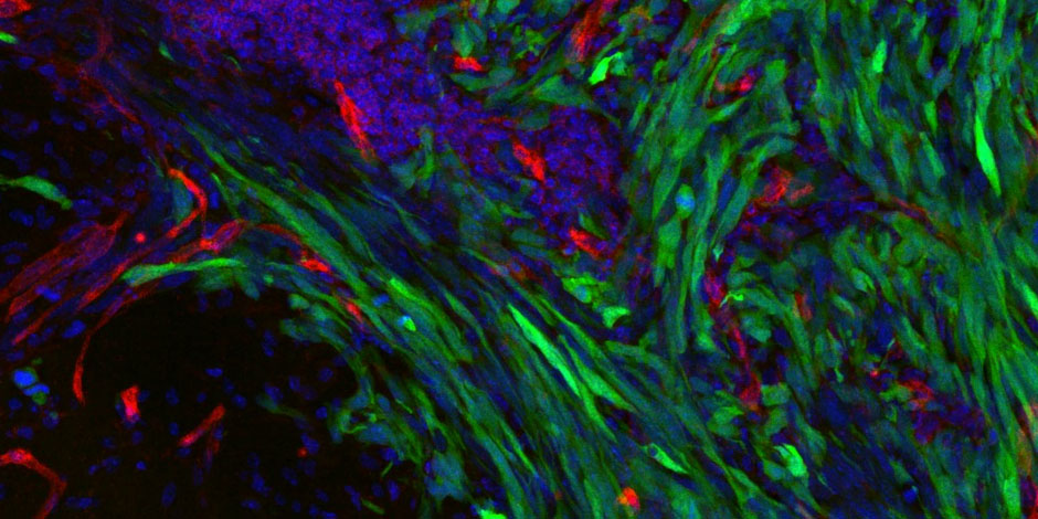 GFP-labelled tumour cells invading normal brain along blood vessels