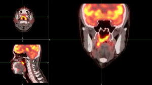 PET Scan head and neck for nasopharynx carcinoma