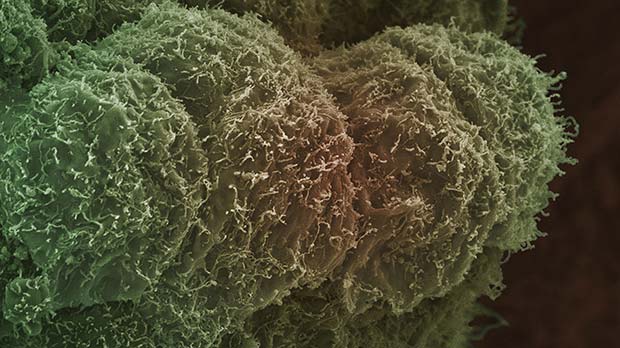 Electron microscope image of a prostate cancer cell.