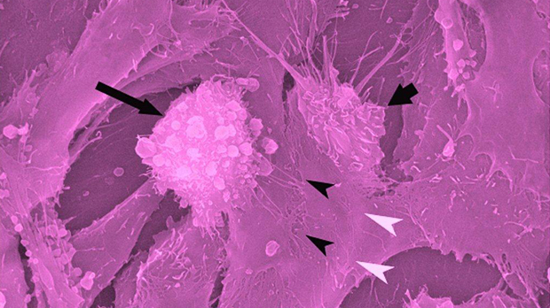 Prostate cancer cells changing shape.