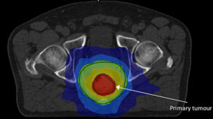 Rectal cancer radiotherapy