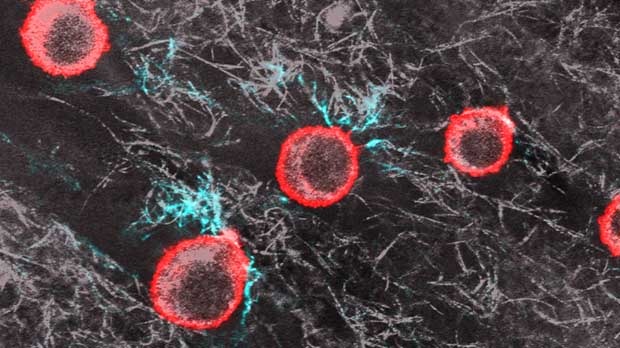 Melanoma cells
