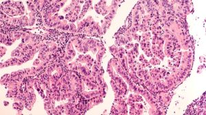Ovarian cancer micrograph