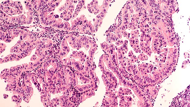Ovarian cancer micrograph