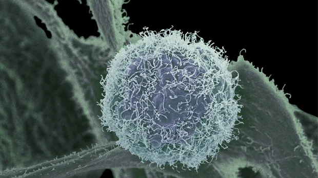 Electron microscopy image of a skin cancer cell