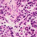 Lung adenocarcinoma cells