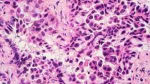 Lung adenocarcinoma cells