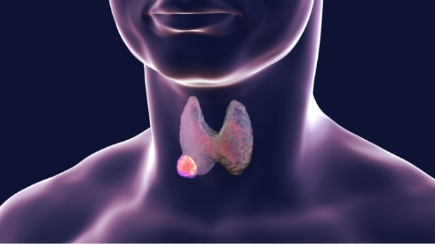 3D visualisation of thyroid cancer