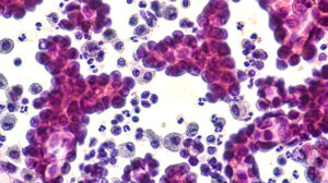 Non small cell lung cancer cells stained in pleural effusion sample.