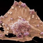 An image of a breast cancer cell taken with a scanning electron microscope
