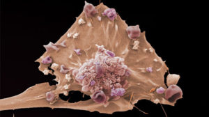 An image of a breast cancer cell taken with a scanning electron microscope