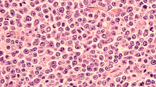 Lymphoma cells
