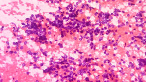 Small cell carcinoma, a type of cancer commonly seen in the lung.
