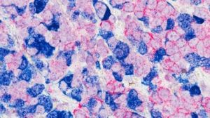 Breast cancer cells