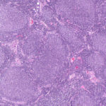 B cell lymphoma seen through a microscope