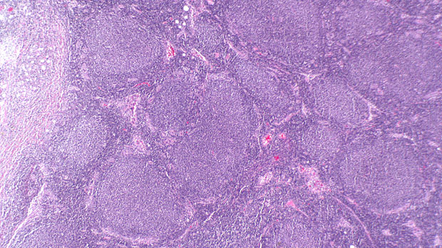 B cell lymphoma seen through a microscope