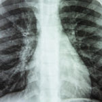 An image of a chest x-ray showing some signs of disease
