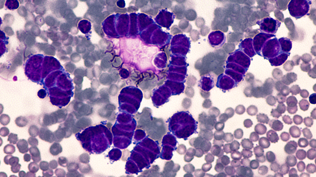 Microscopic image of pleural fluid cytology of a small cell carcinoma