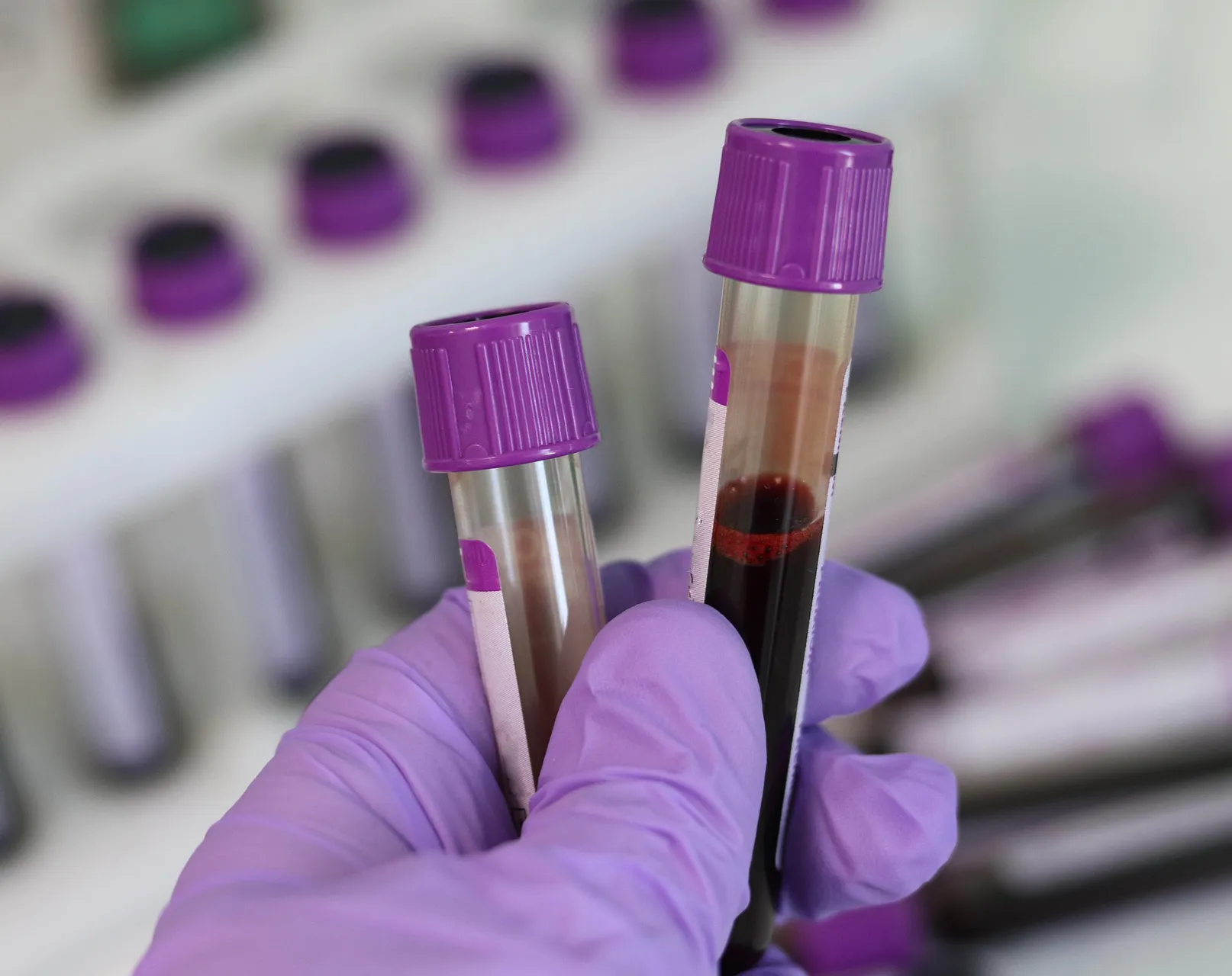 Image showing two vials of blood in a researchers hand