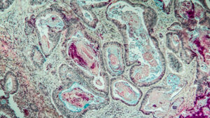 Bowel cancer cells under the microscope
