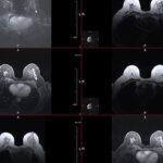 Breast magnetic resonance image, or MRI. The bright white dot in the larger images is stage one breast cancer.
