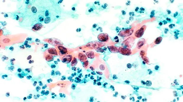 A magnified image of squamous cell carcinoma, the most common type of cervical cancer