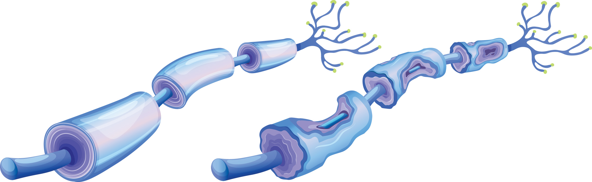 An illustration showing a damaged peripheral nerve cell next to a healthy one.