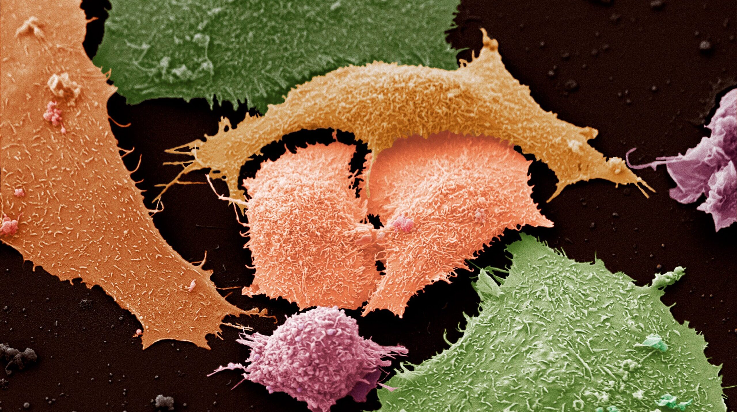 Lung cancer cells seen through a microscope.