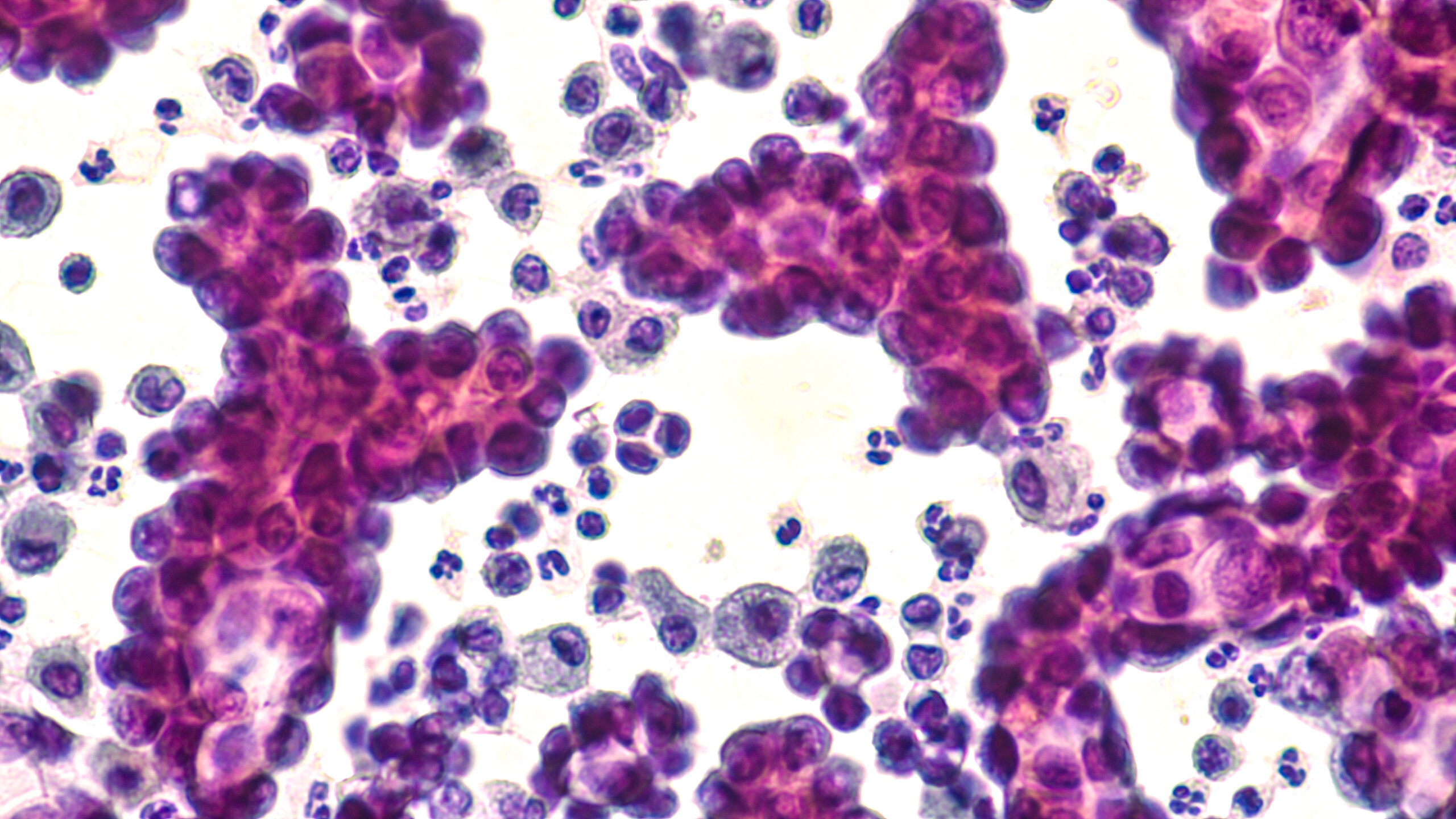 Non small cell lung cancer cells through a microscope.