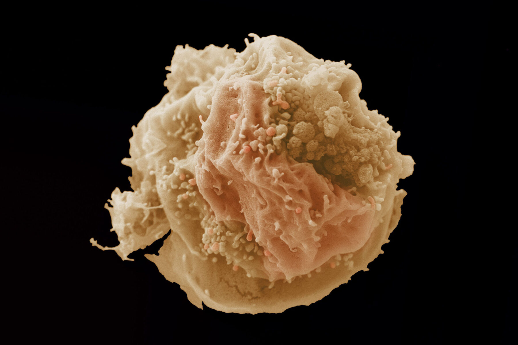 A breast cancer cell seen through an electron microscope.