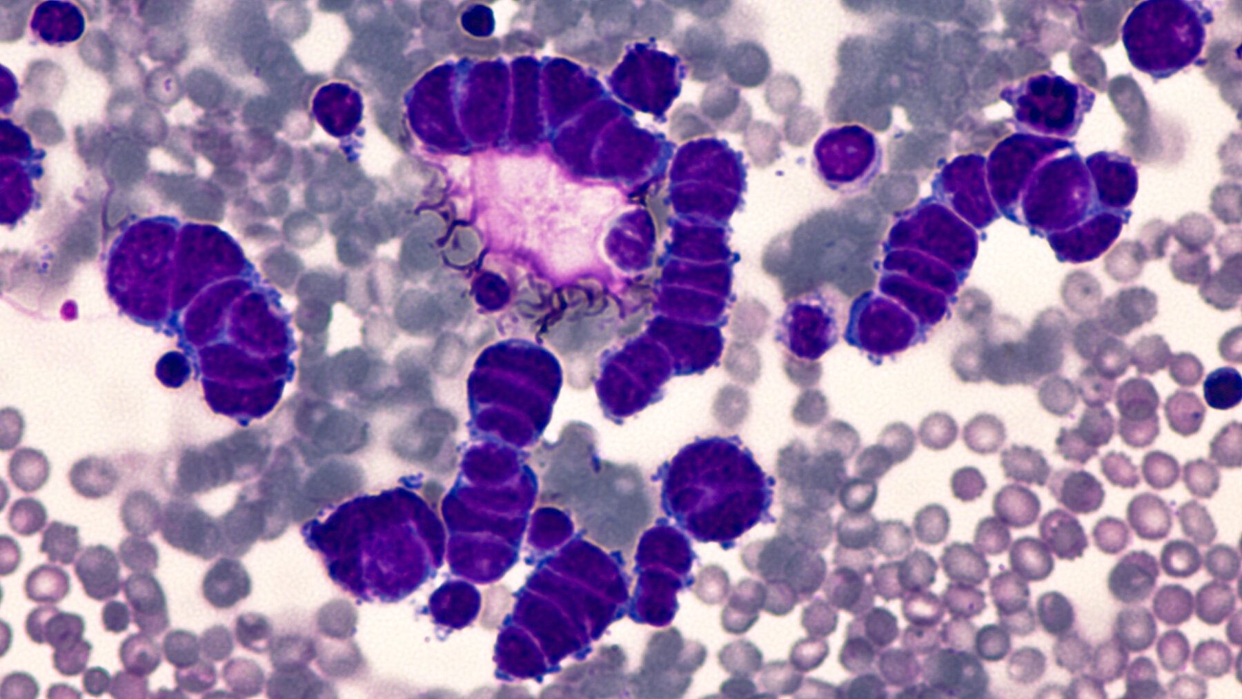 Microscopic images of pleural fluid cytology of a small cell oat cell carcinoma