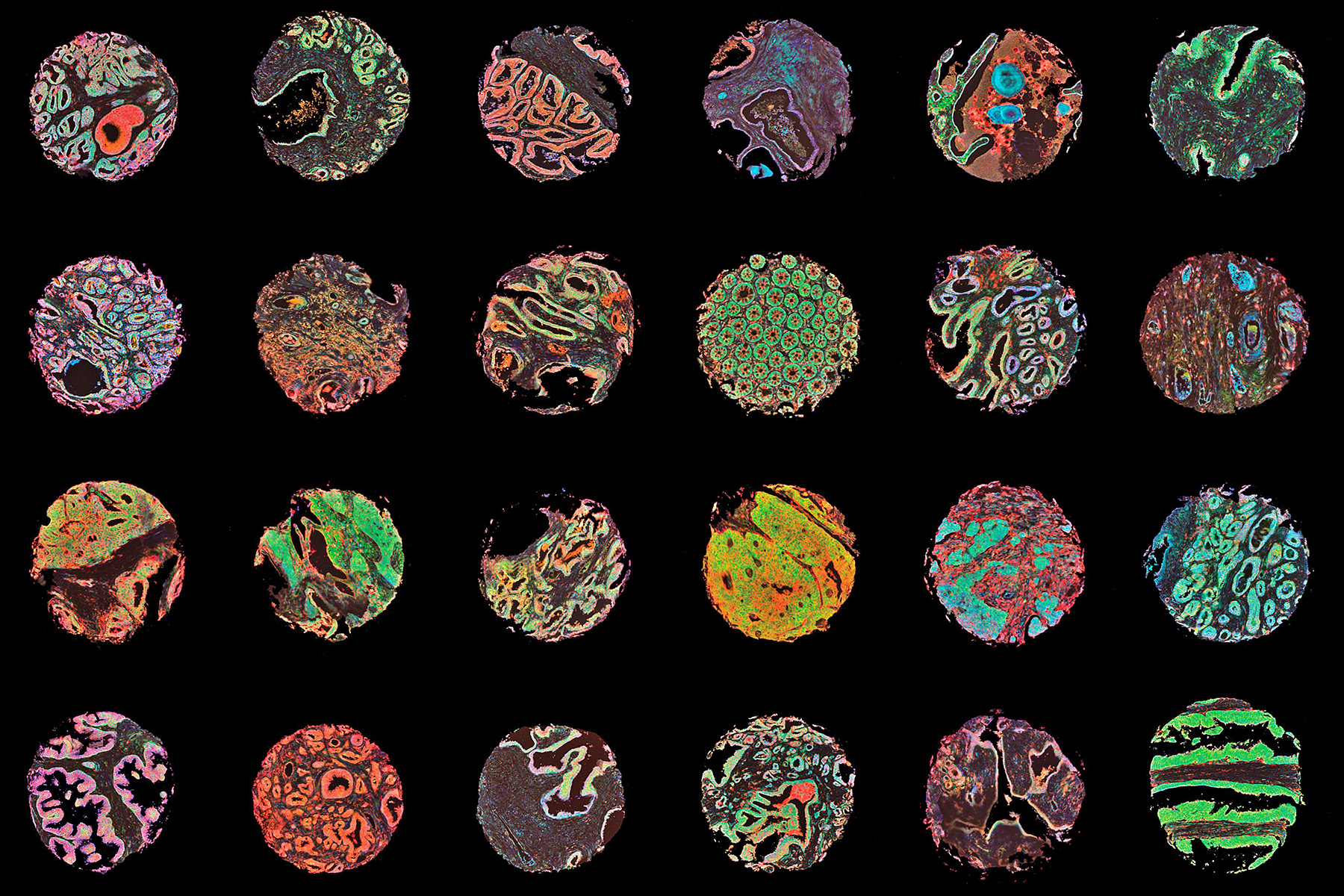 An array of normal and cancerous human tissue samples.