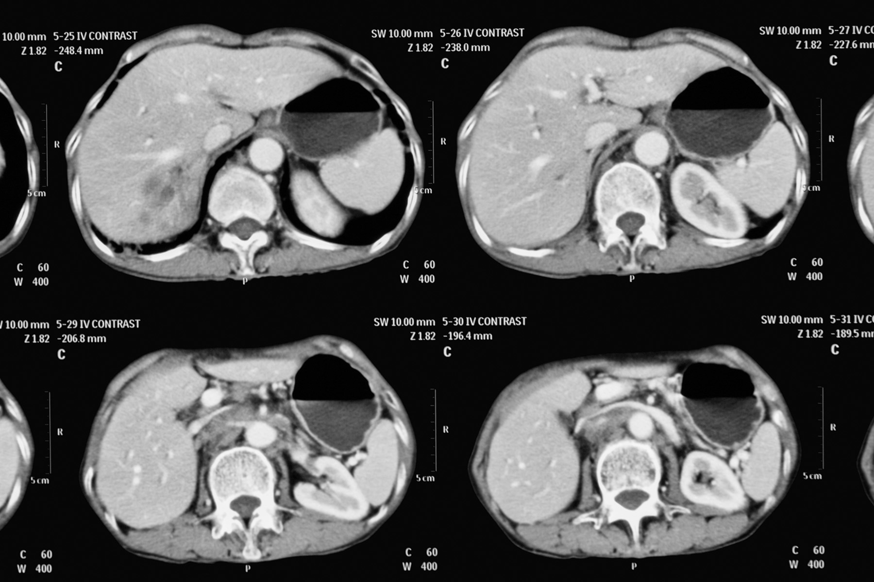 A CT scan showing a bile duct cancer (cholangiocarcinoma)