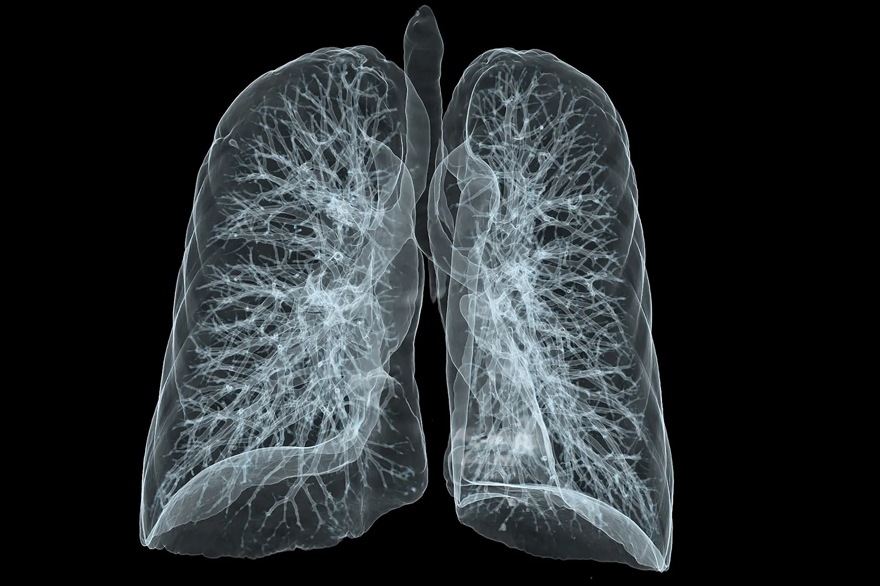 A CT scan of someone's lungs