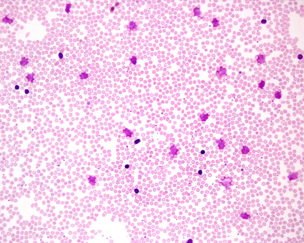 A blood smear showing the presence of chronic lymphocytic leukaemia cells (dark purple)