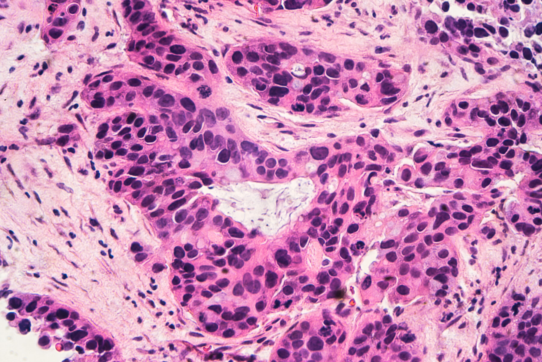Breast cancer cells taken as part of a biopsy shown under the microscope