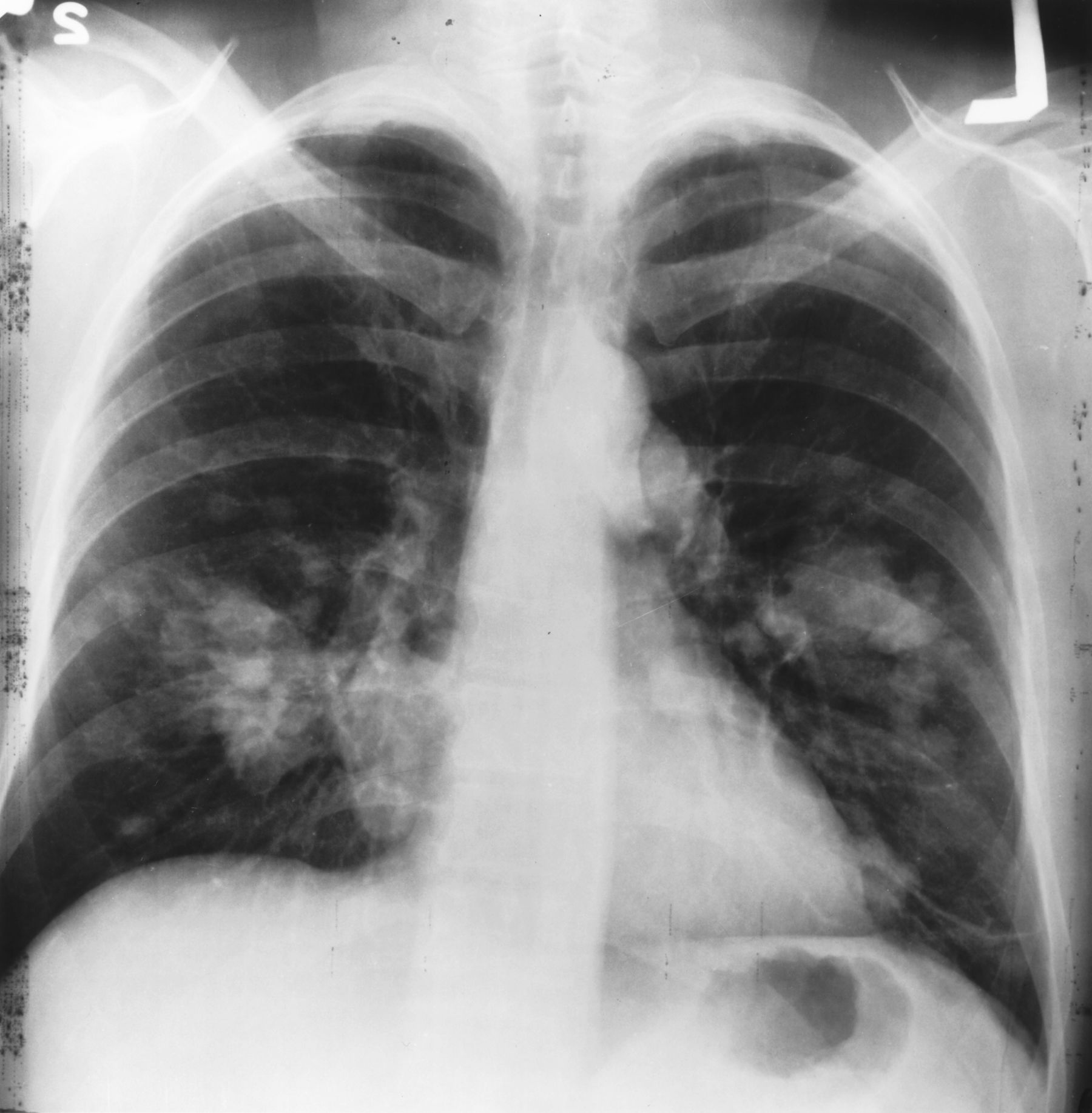 An image of a chest x ray