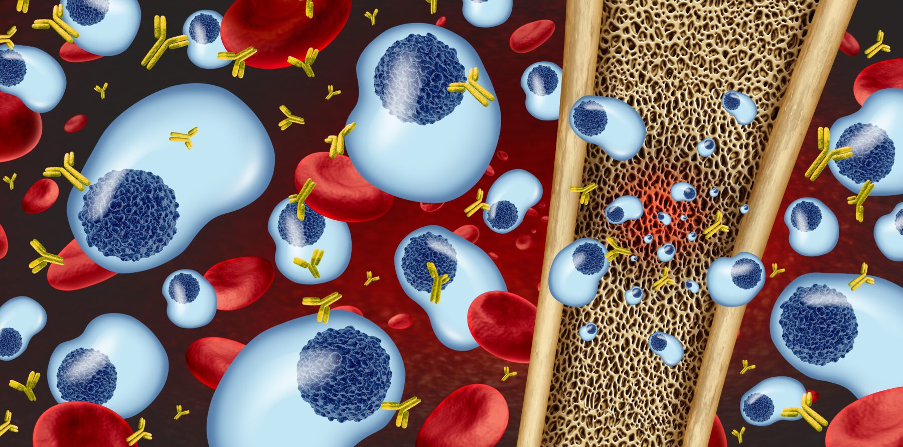 Multiple myeloma is an incurable malignancy of immunoglobulin-secreting plasma cells