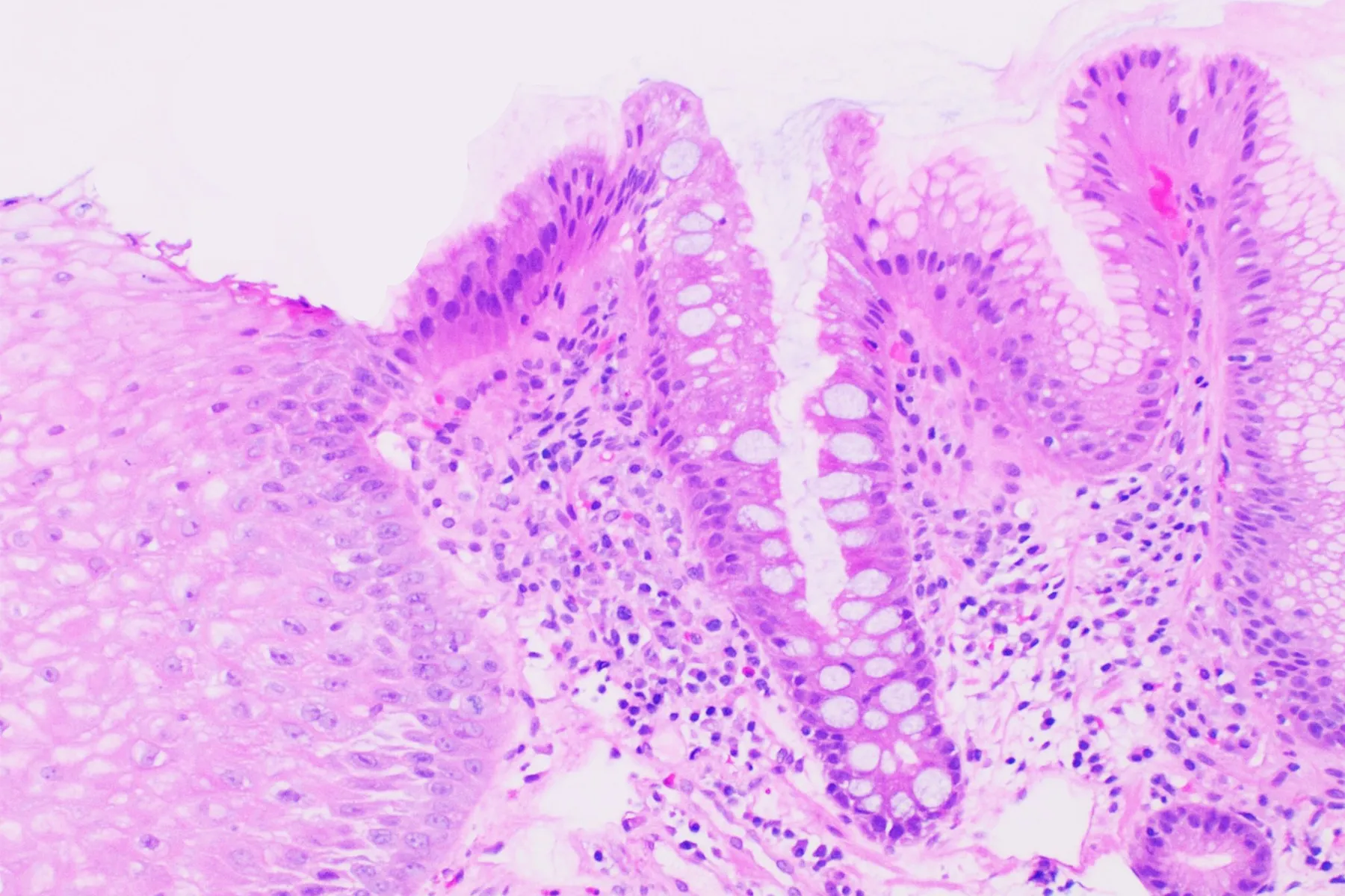 A microscope image showing cells affected by Barrett's oesophagus, a precancer that can lead to oesophageal cancer.