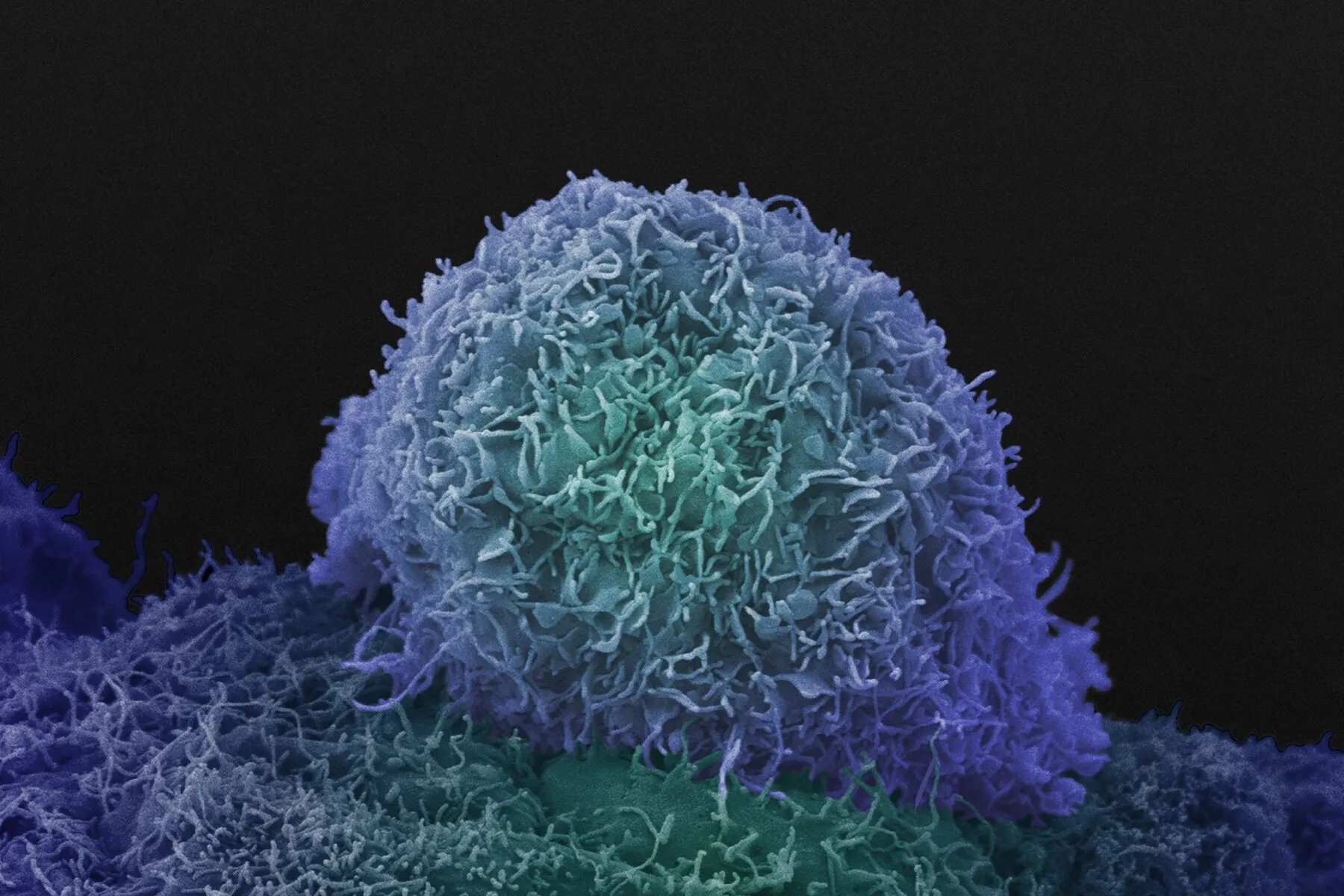 Prostate Cancer cell image taken using a Scanning Electron Microscope