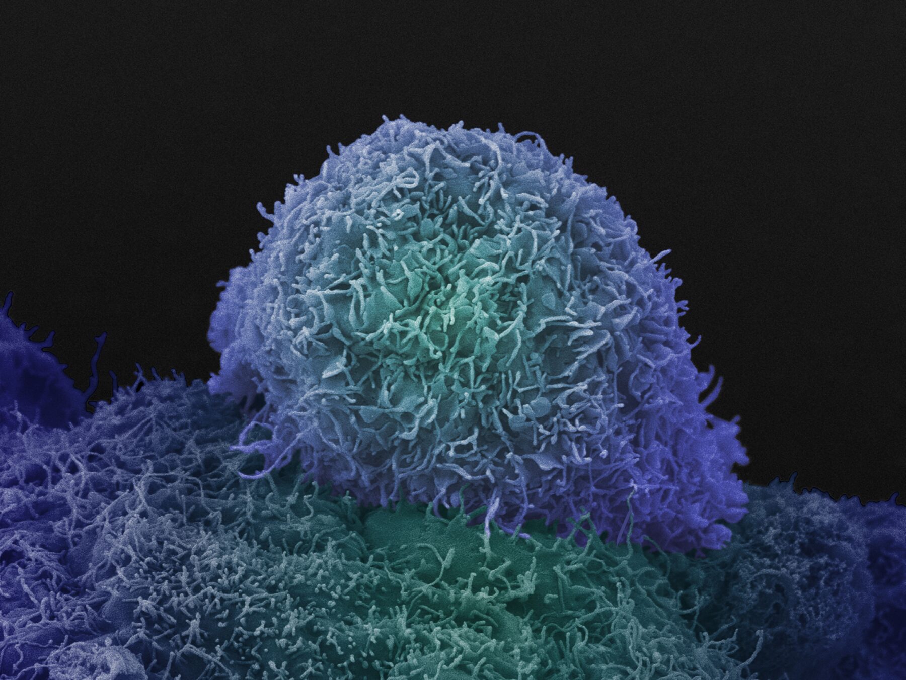 Prostate Cancer cell image taken using a Scanning Electron Microscope