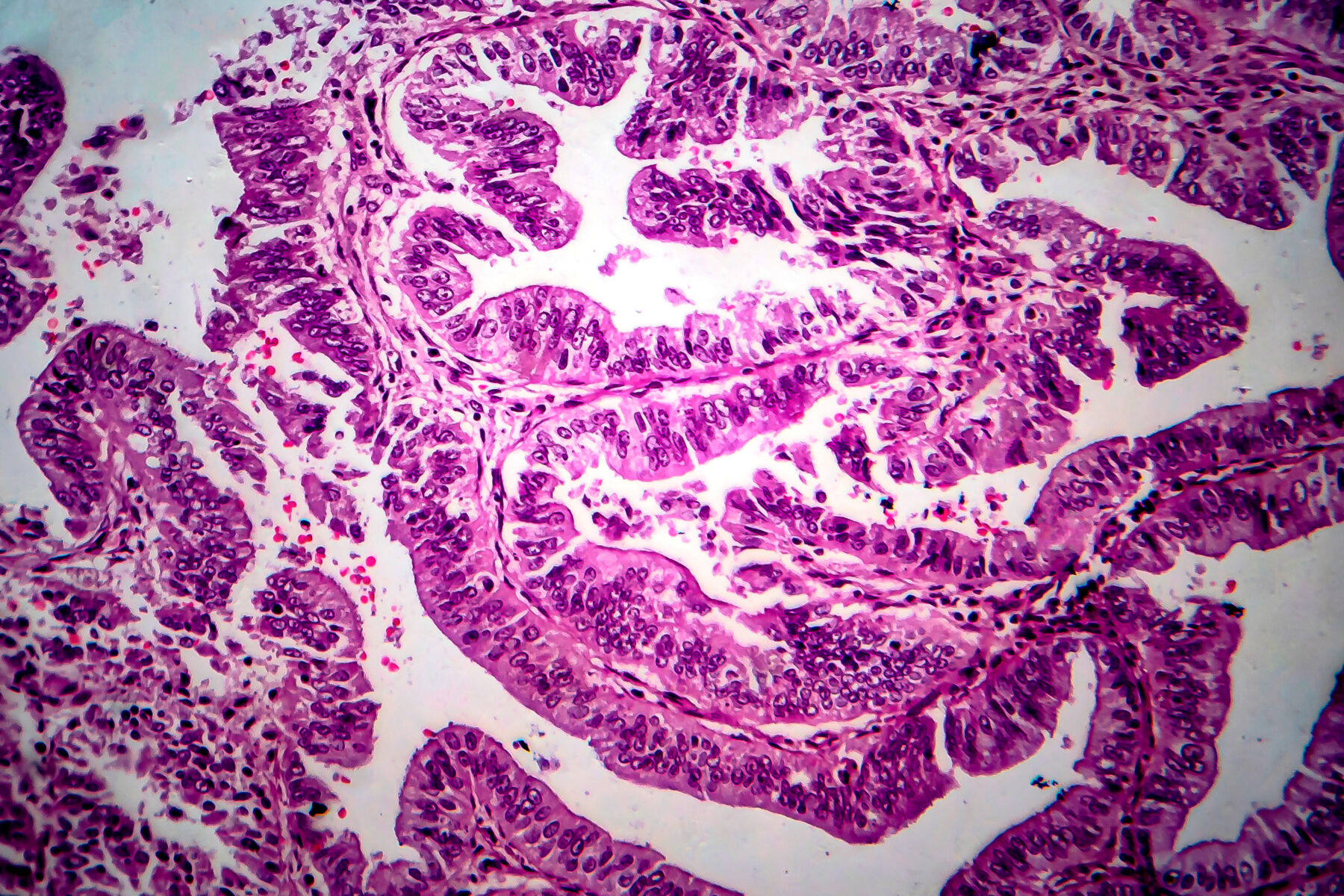Endometrial adenocarcinoma cells viewed under the microscope